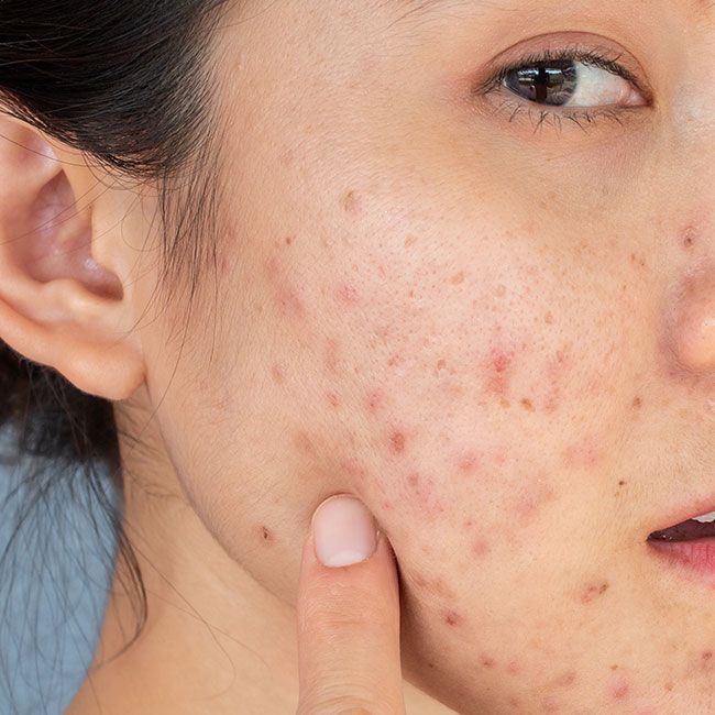 DARK SPOT REMOVER